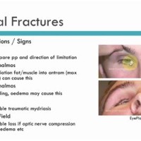 Orbital Floor Fracture Surgery Complications | Review Home Decor